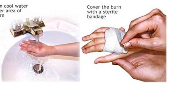 first degree burn treatment