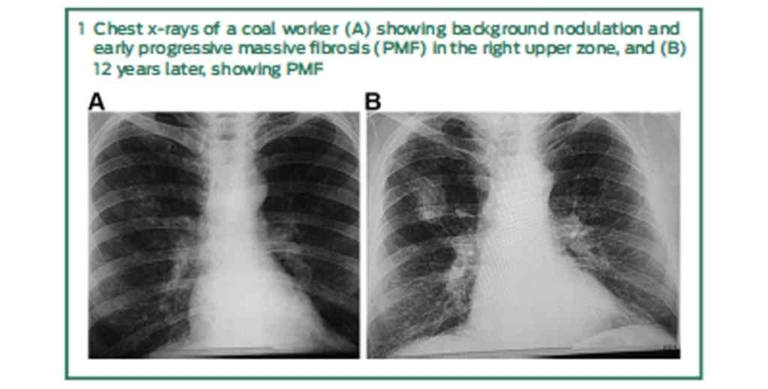 Coal Workers’ Pneumoconiosis: An Australian Perspective 